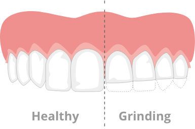 Diagram of healthy teeth versus grinding teeth